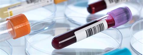 ceruloplasmin blood test bottle|ceruloplasmin vs copper level.